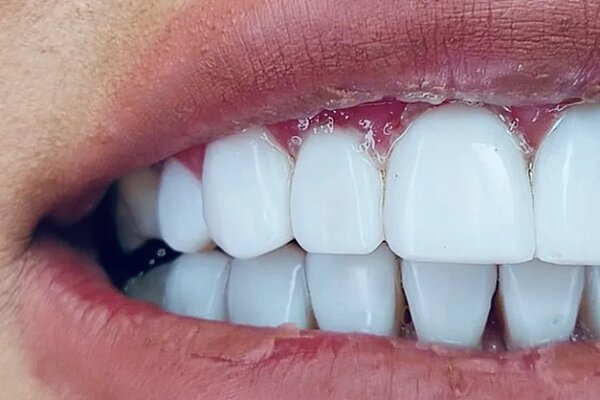 نگرانیهای دندانپزشکی در بارداری