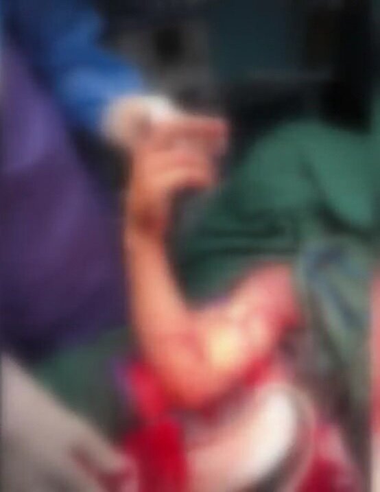 یک جراحی کمنظیر در بروجرد؛ دست قطعشده نوجوان دوباره به بدن بازگشت یک جراحی کمنظیر در بروجرد؛ دست قطعشده نوجوان دوباره به بدن بازگشت